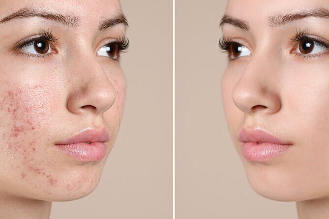 Skin Glo Package w/microderm/LED- For 2 with Appetizers and Wine - Who Is This Experience Best For?